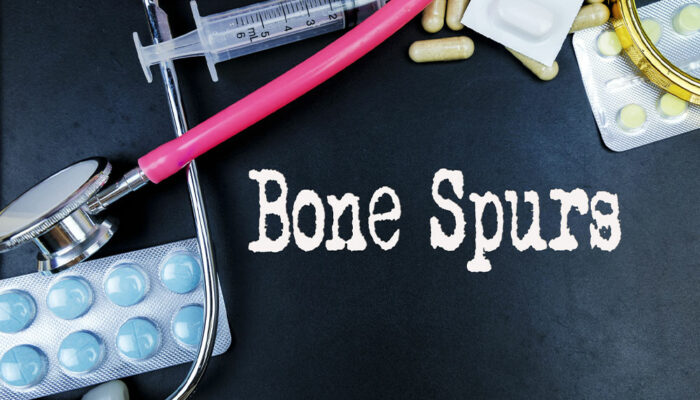 Bone Spurs – Causes, Types, and Management Options