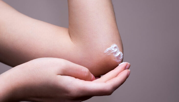 Ringworm – Transmission, Risk factors, and More