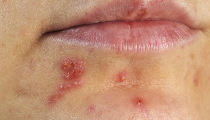 4 effective ways to treat herpes