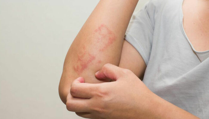 Here’s all that you need to know about scabies skin rash