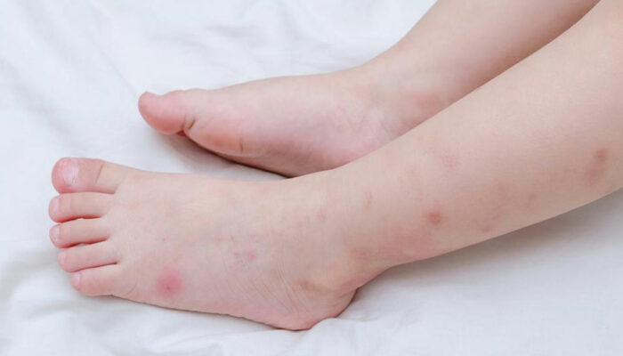 Here’s how to identify insect bites quickly