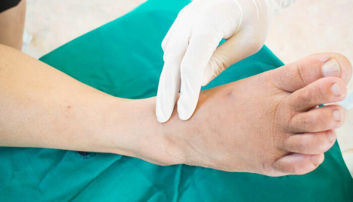 Here’s what you need to know about neuropathy symptoms and more