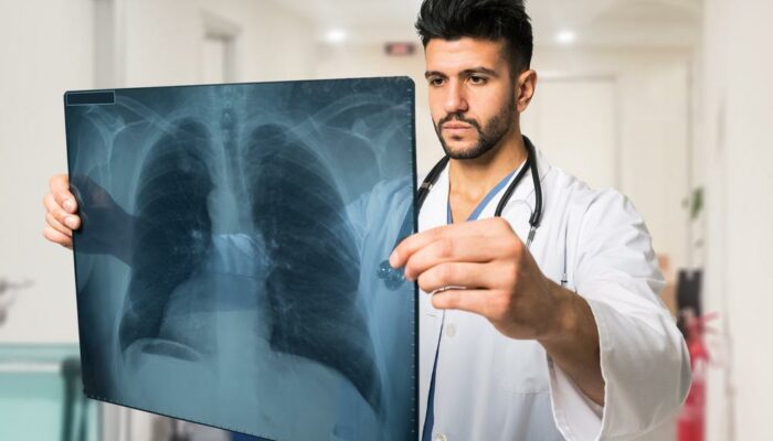 Lung Cancer – Causes, Symptoms, and Treatment