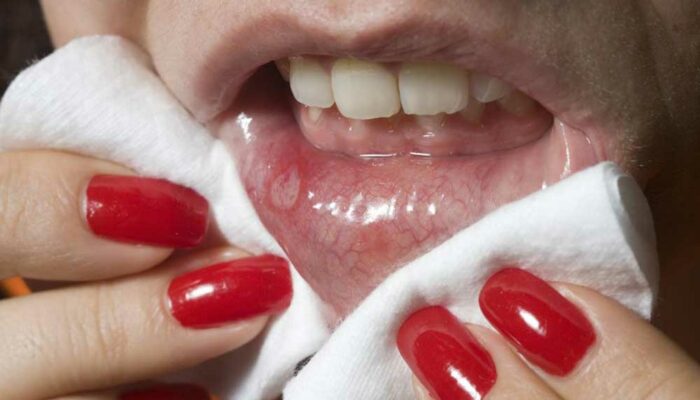 Mouth Cancer – Causes and Symptoms