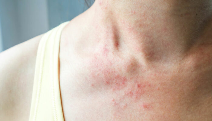 Mycosis fungoides – more than just a skin rash