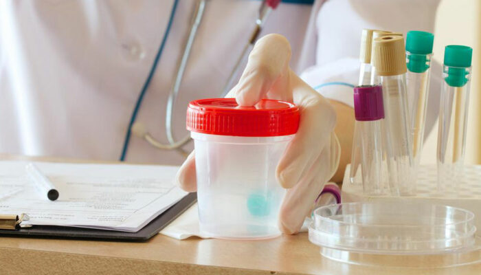Proteinuria – The process of protein in urine test