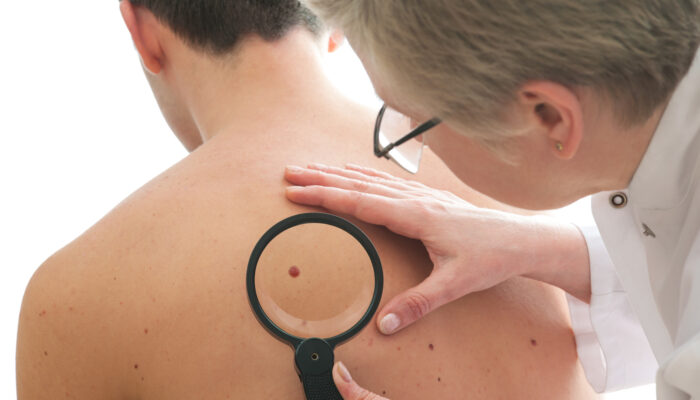 All About Cellulitis – Causes, Symptoms, And Treatment