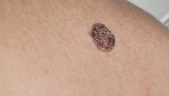 Carcinoma – Types, symptoms, and other important information you should know