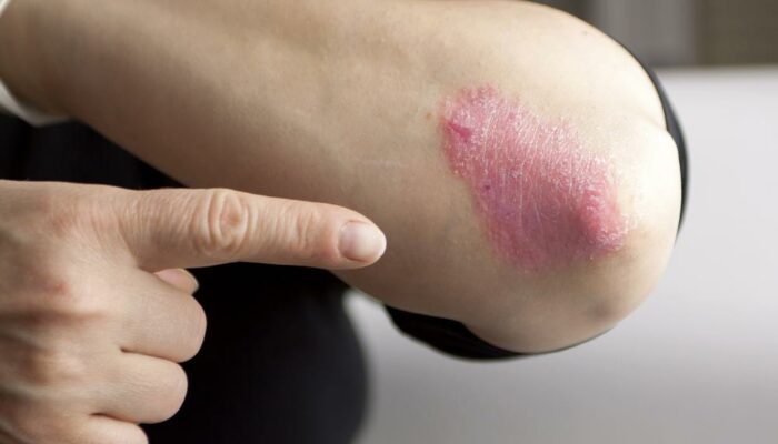 Causes of psoriasis that one needs to be aware of