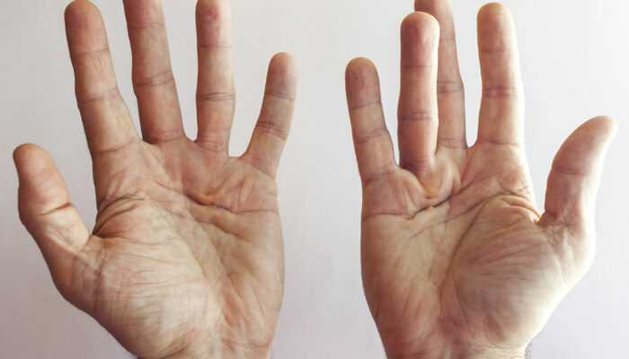 Dupuytren’s Contracture – Its Symptoms and Causes