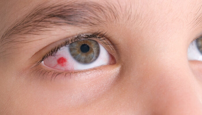 Eye infections – All you need to know