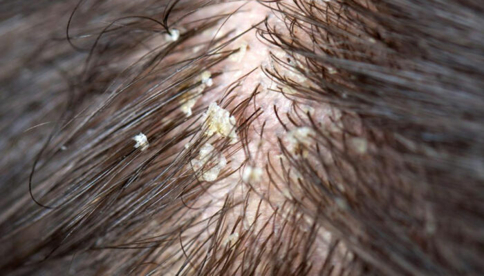 Get Rid of Dry Scalp with Nature’s Care