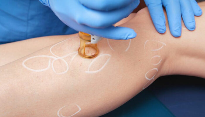 Here’s what you need to know about leg cellulitis treatment