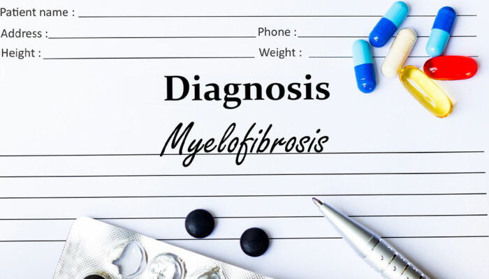 Myelofibrosis – Symptoms, causes, and management options