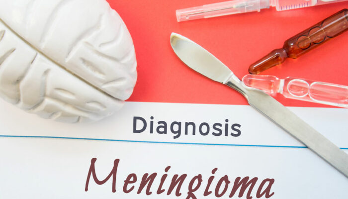 Meningioma – Symptoms, Causes, Diagnosis, and More