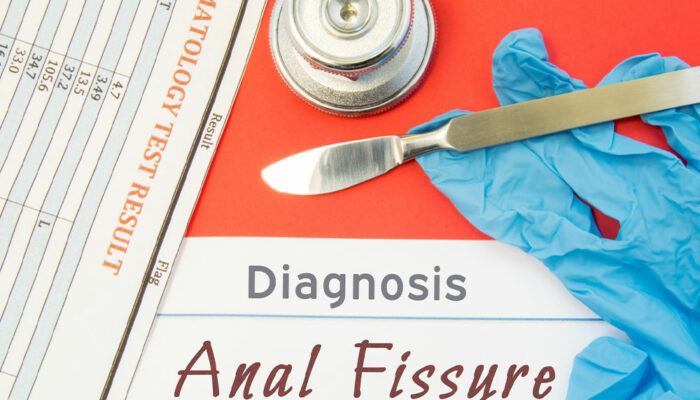 Anal Fissures – Its Causes, Symptoms, and Management