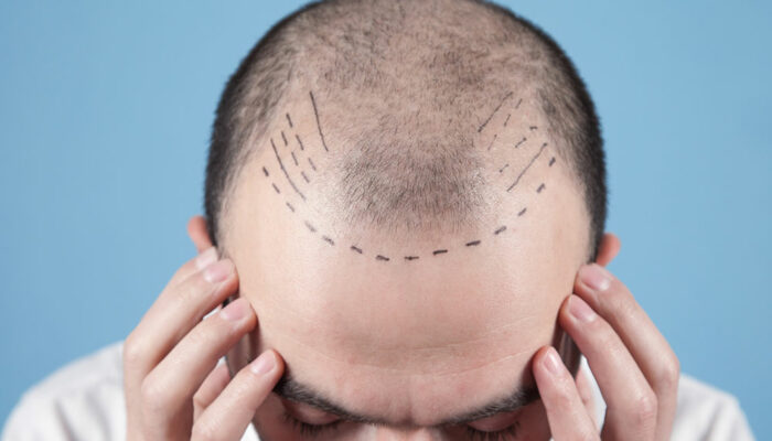 Hair Transplant – Techniques, Costs, and More