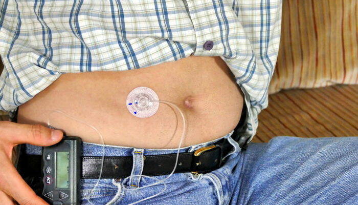 Insulin Pumps for Type 1 Diabetes – Types and Benefits