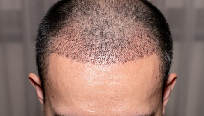 Hair Transplant – Types, Benefits, and Tips to Choose a Doctor