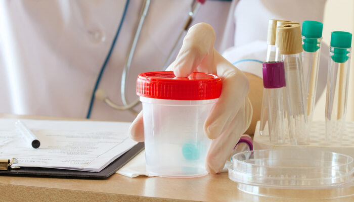 Cloudy Urine – Causes and Home Remedies